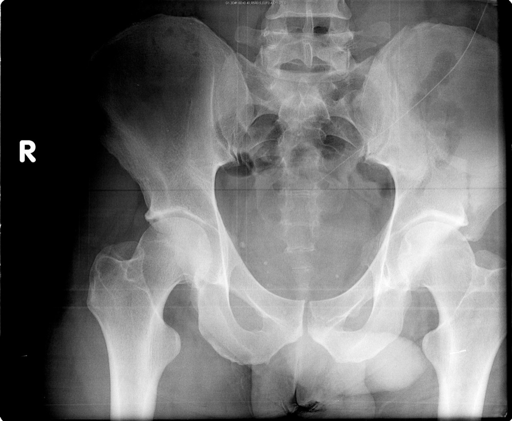 the-pelvis-and-hip